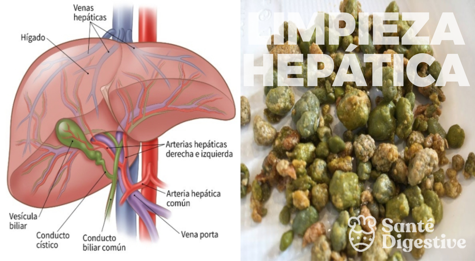 Limpieza Hepática de vias biliares
