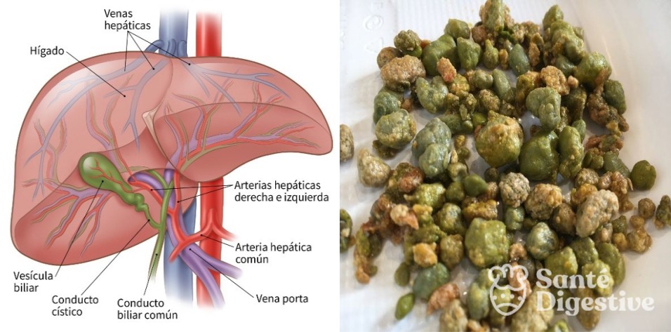 Limpieza Hepática de vias Biliares